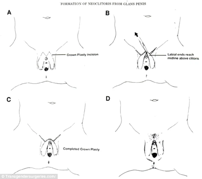 vaginoplastie grafic