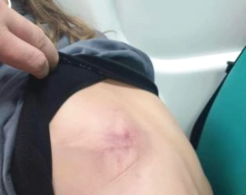 Traumatism toracic provocat cu o coadâ de mătură de părintele agresiv FOTO Facebook Catrinel Cojocaru