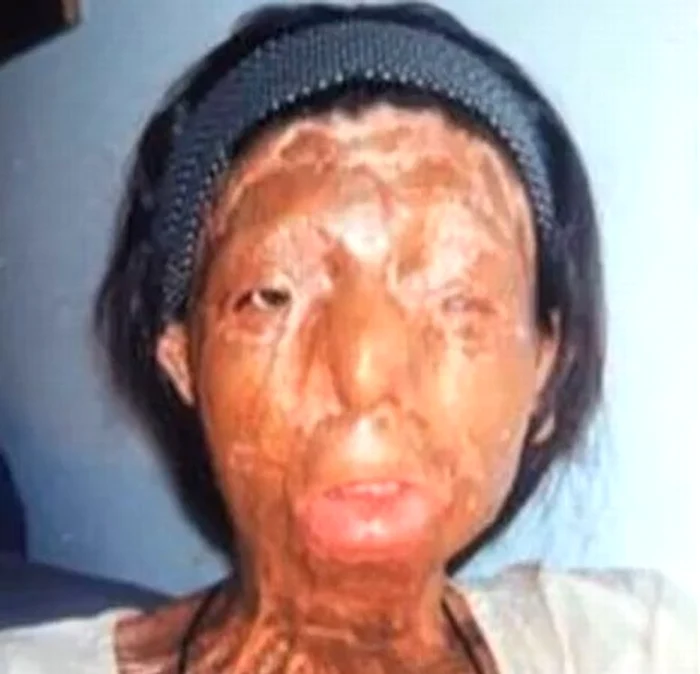 Tânăra a fost distrusa de acid