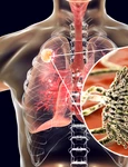 infectie Aspergillus fumigatus jpg