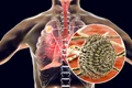 infectie Aspergillus fumigatus jpg