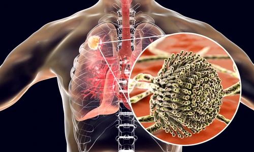 infectie Aspergillus fumigatus jpg