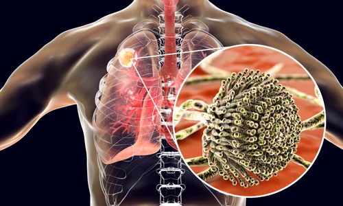infectie Aspergillus fumigatus jpg