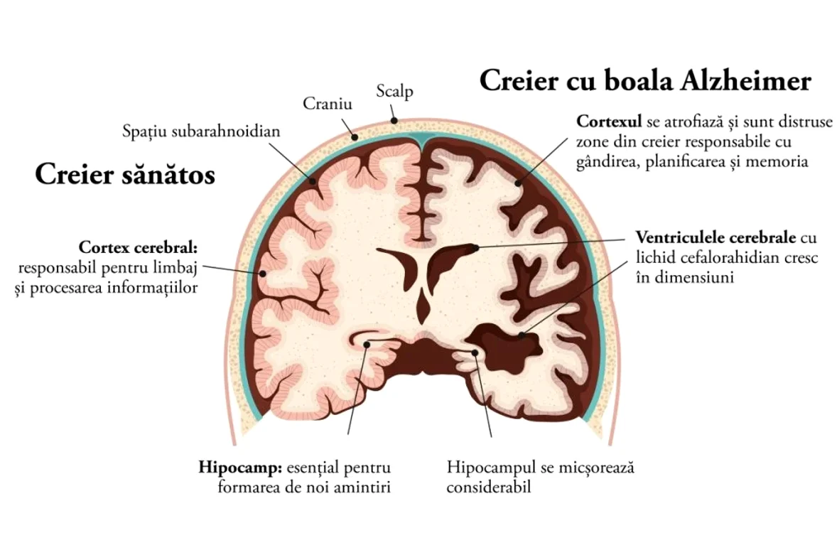 Comparație creier bolnab-creier sănătos la Alzheimer
