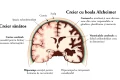 boala alzheimer simptome debut evolutie si tratament anatomie 1024x652 webp
