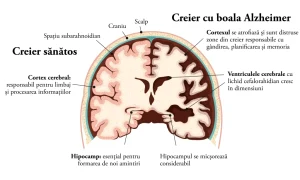 boala alzheimer simptome debut evolutie si tratament anatomie 1024x652 webp