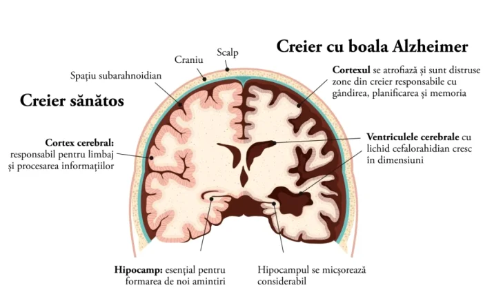 Comparație creier bolnab-creier sănătos la Alzheimer