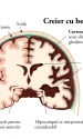 boala alzheimer simptome debut evolutie si tratament anatomie 1024x652 webp