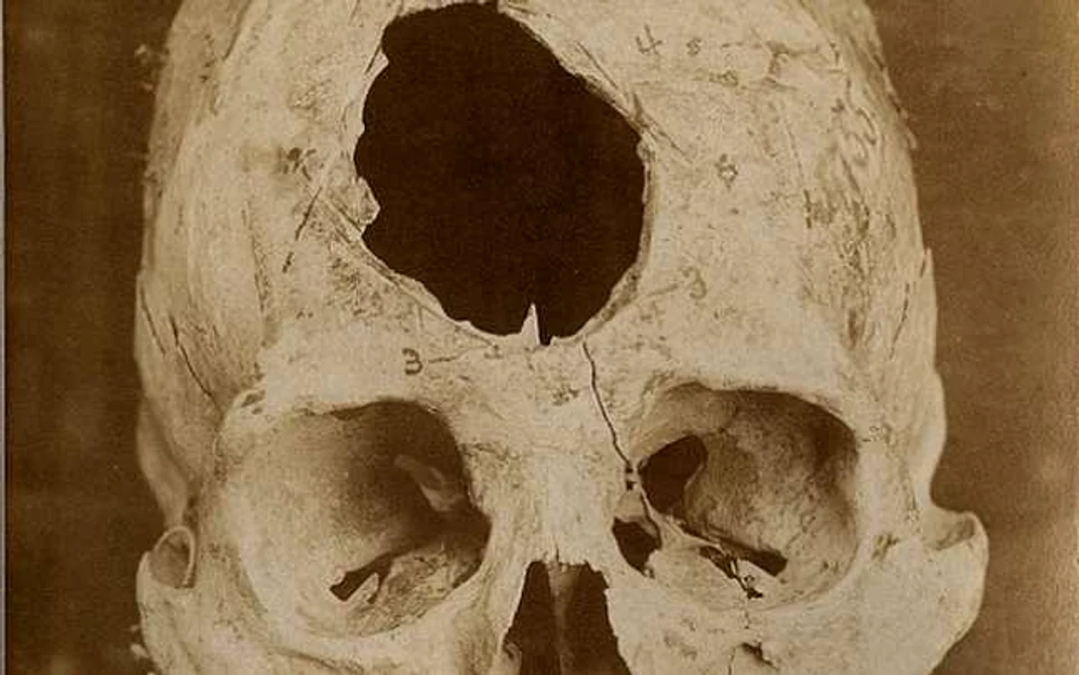 Craniu peruvian din neolitic trepanat FOTO vice.com
