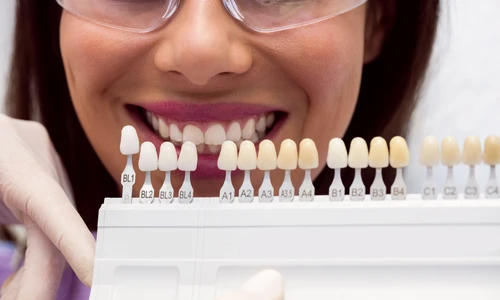 De ce să alegi fațete dentare în locul albirilor dentare frecvente jpg