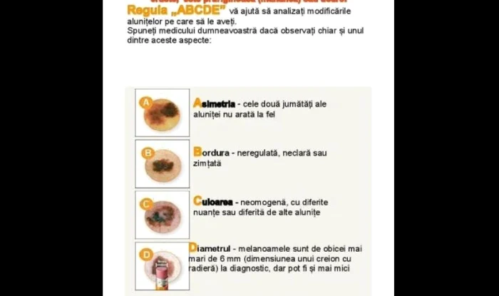 Şapte lucruri importante despre melanomul malign. Există o asociere cu istoricul arsurilor solare la vârste fragede