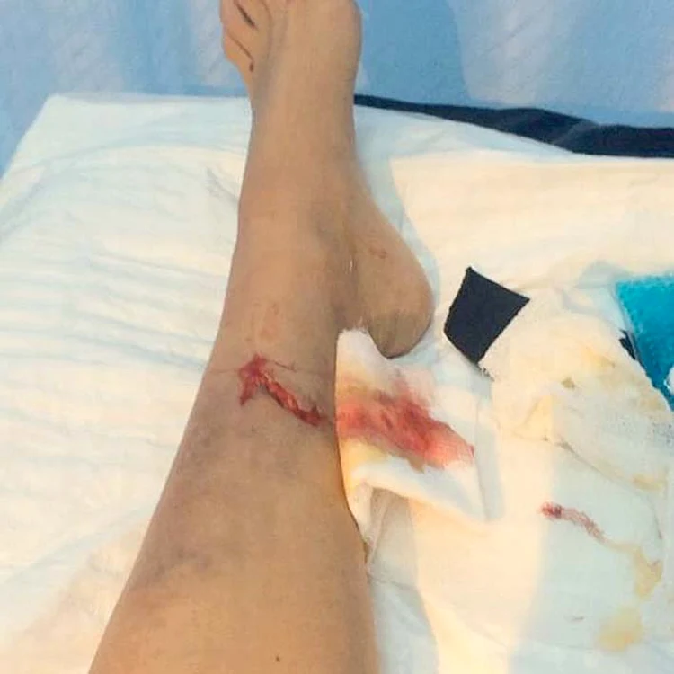 Tăietura pe care a  suferit-o acum este la acelaşi picior la  care roşcata a avut  necazuri şi în trecut
