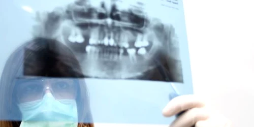 O radiografie panoramică iradiază de trei-patru ori mai mult decât una simplă