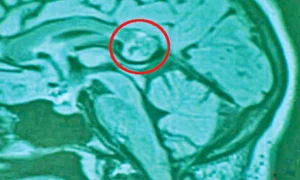 Geamănul nu era  dezvoltat, dar i se  formaseră oasele, părul şi dinţii jpeg