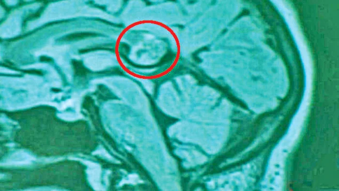 Geamănul nu era  dezvoltat, dar i se  formaseră oasele, părul şi dinţii