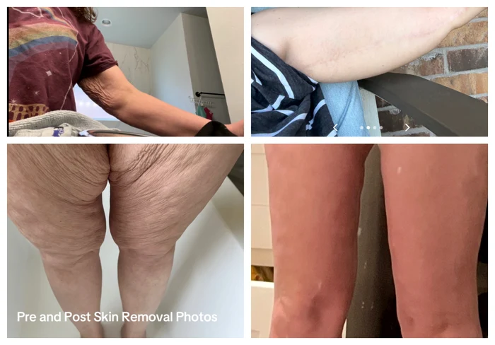 Transformarea unei femei i-a lăsat pe internauți cu gura căscată: „I-a șters 20 de ani!” Ea a apelat la lifting facial în Mexic 5 Poze de dinainte și după cu pielea lăsată