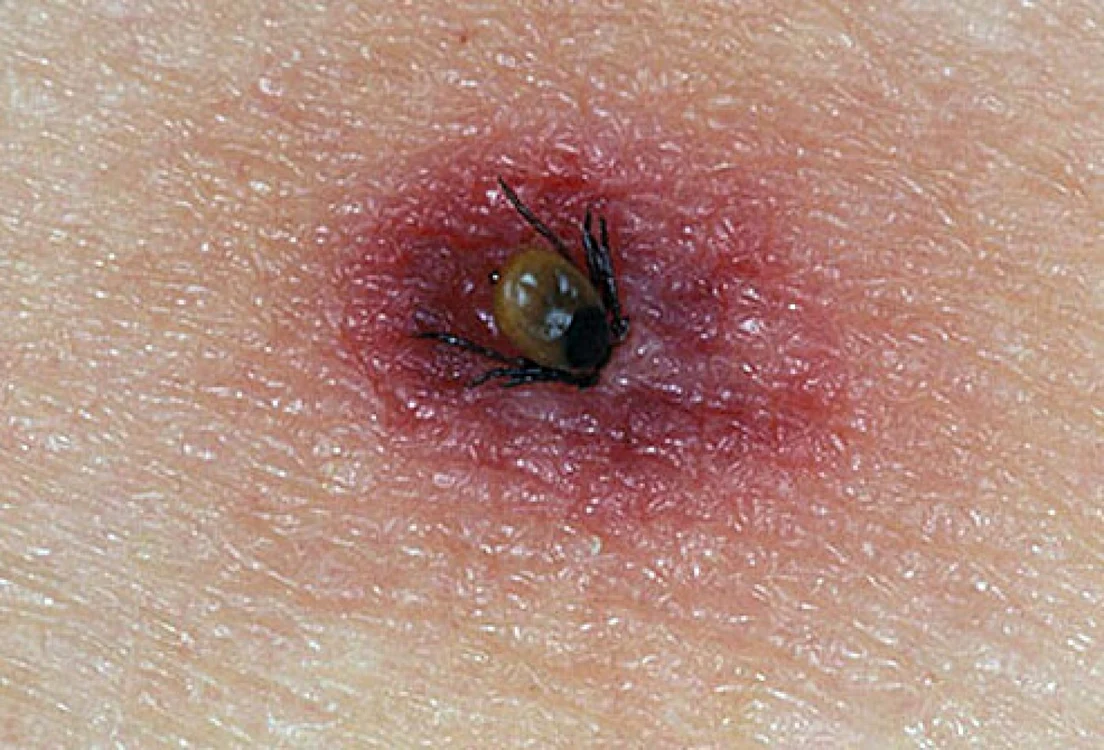 Lyme OnHealth