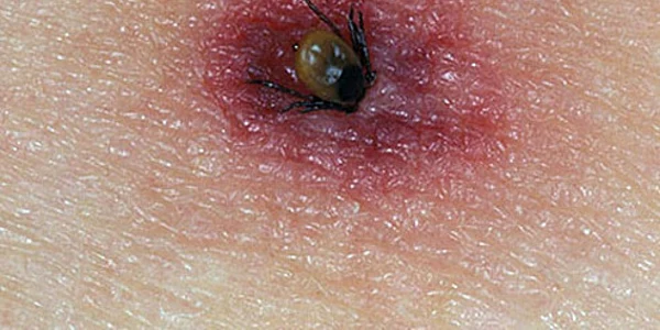 Lyme OnHealth