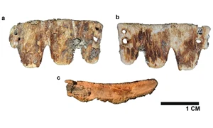 Puntea dentară din secolul al XIX-lea descoperită în Portugalia (© Vassallo et al., International Journal of Osteoarchaeology, 2026)