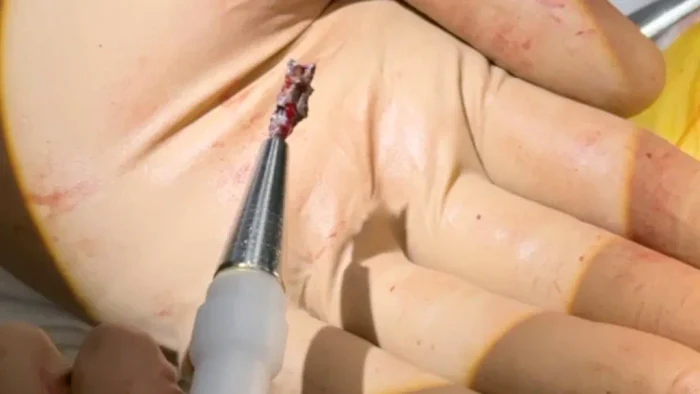 Srapnelul extras din inima soldatului ucraineanean FOTO Centrul de chirurgie cardiacă Dnipro