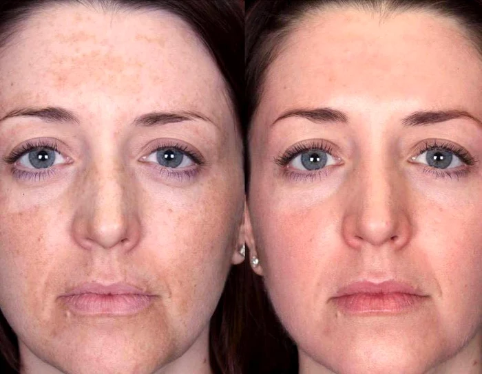 
    Tenul trebuie protejat cu creme cu SPFFoto: arhivă personală  