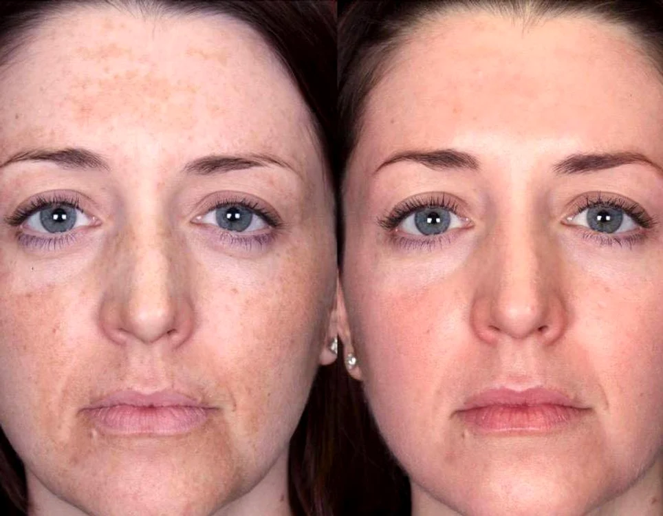 Tenul trebuie protejat cu creme cu SPF