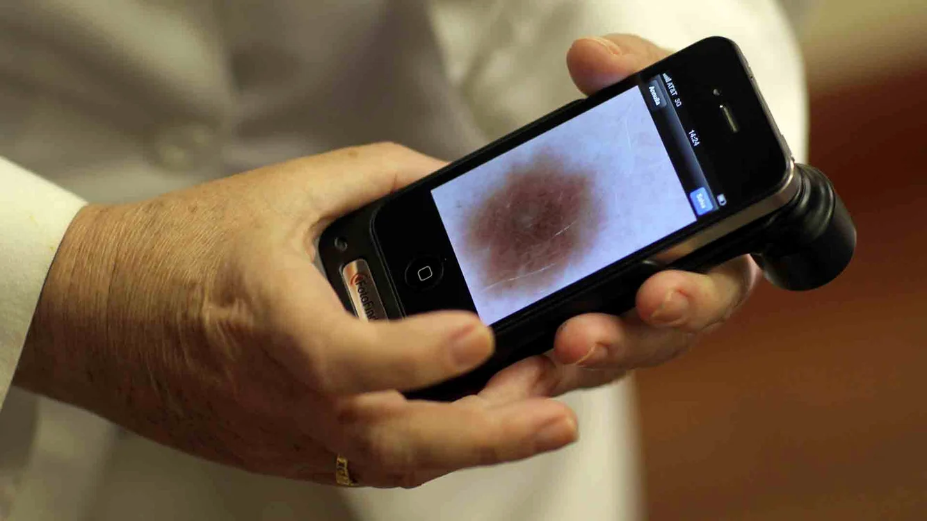
    Dispozitivele moderne ar putea duce la cancer de piele  