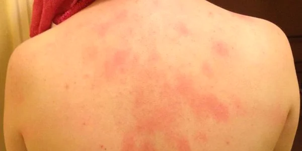 alergie urticarie piele iritatii piele 