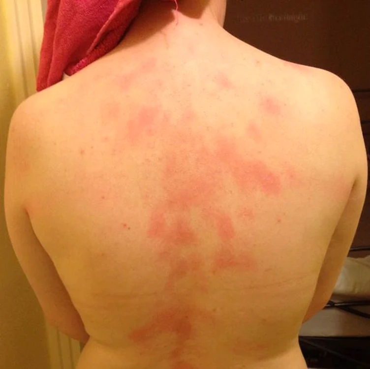 Urticaria este una dintre cele mai neplăcute boli de piele. FOTO Arhivă.