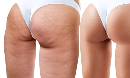 Exerciţii pentru celulită Top 10 mişcări care elimină aspectul de coajă de portocală jpeg