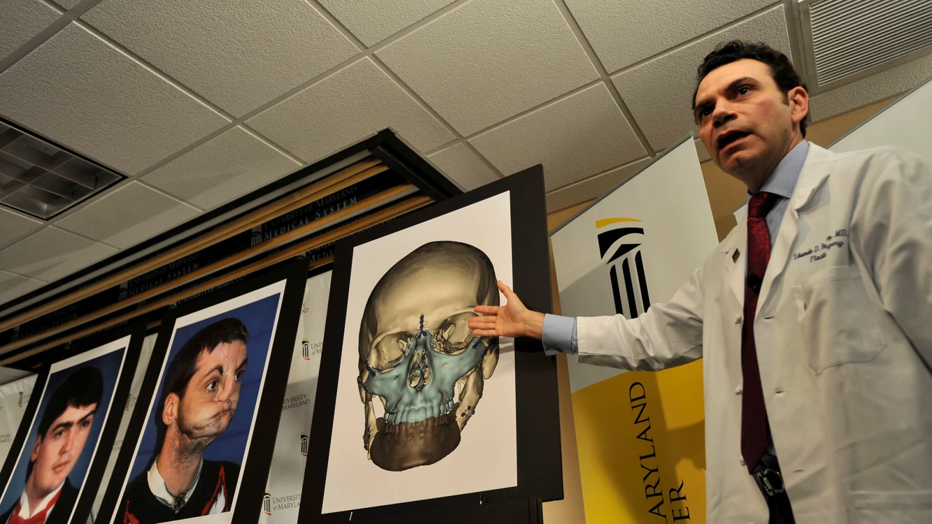 Medicul Sergio Canavero ar vrea să realizeze primul transplant de cap la Londra