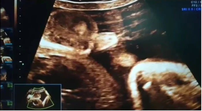 Bebeluşul face pipi în burticăfoto: captura Facebook dr. Gheorghe Gică