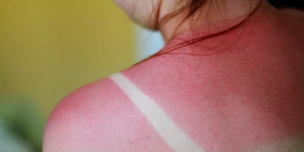 arsuri solare SfatFarma