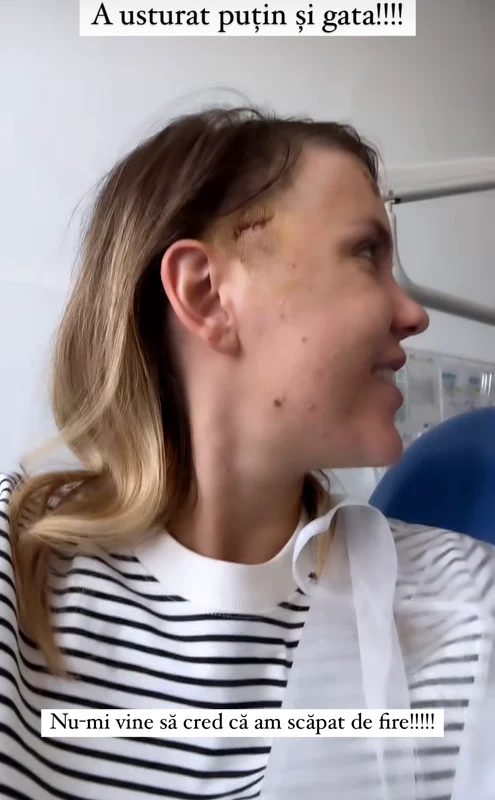 Cunoscuta influenceriță este acum fericită pentru că la câteva zile după ce i-a fost scoasă tija, în sfârșit, a scăpat și de firele de la operație