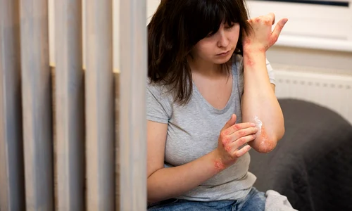 hands patient suffering from psoriasis jpg