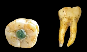 External view of the molar webp