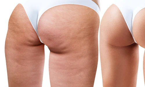 1 celulita alimente interzise png png