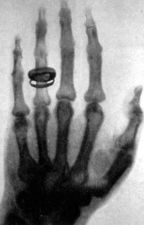 Prima radiografie din lume. Foto wikipedia