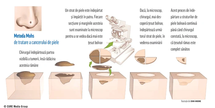 Așa se efectuează operația Mohs