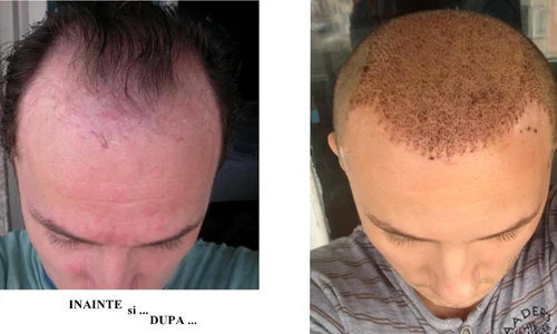 mihai traistariu implant de par 4 jpeg