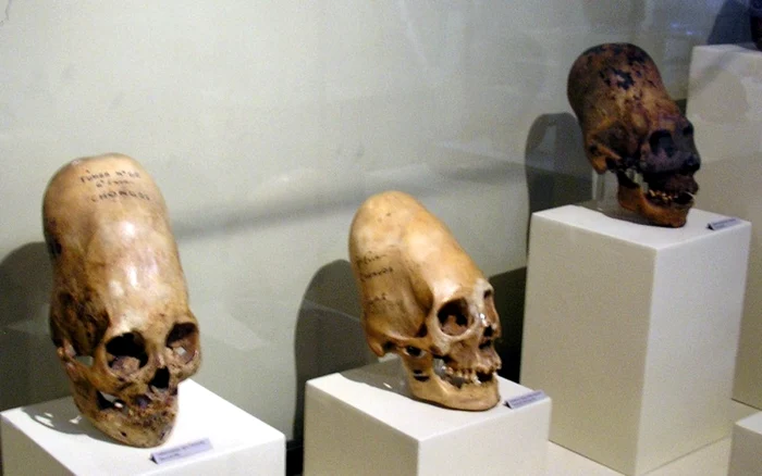 Deformare artificiala a craniului