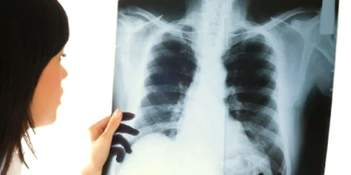 O tomografie computerizată  este de până la 500 de ori mai iradiantă decât o radiografie clasică