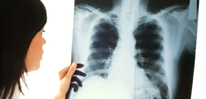 O tomografie computerizată  este de până la 500 de ori mai iradiantă decât o radiografie clasică