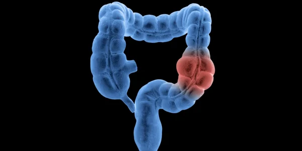 cancer de colon