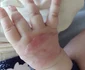 Reacția alergică a unui bebeluș internat în Secția Pediatrie a Spitalului Județean de Urgență Vâlcea Foto captură video jpg