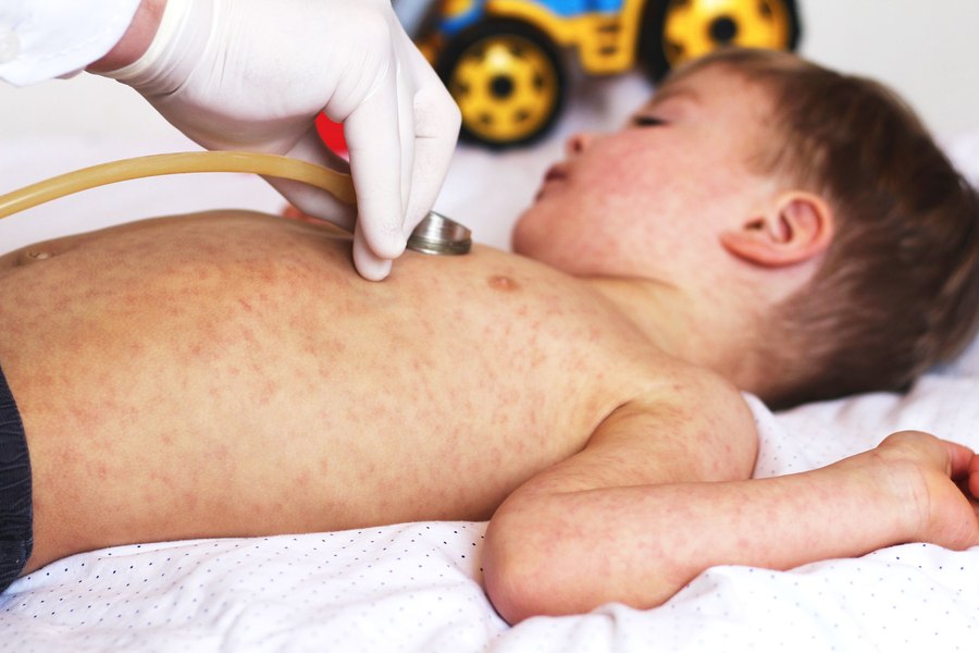 OMS face apel pentru vaccinarea copiilor împotriva rujeolei. Creștere fulminantă a numărului de cazuri în Europa
