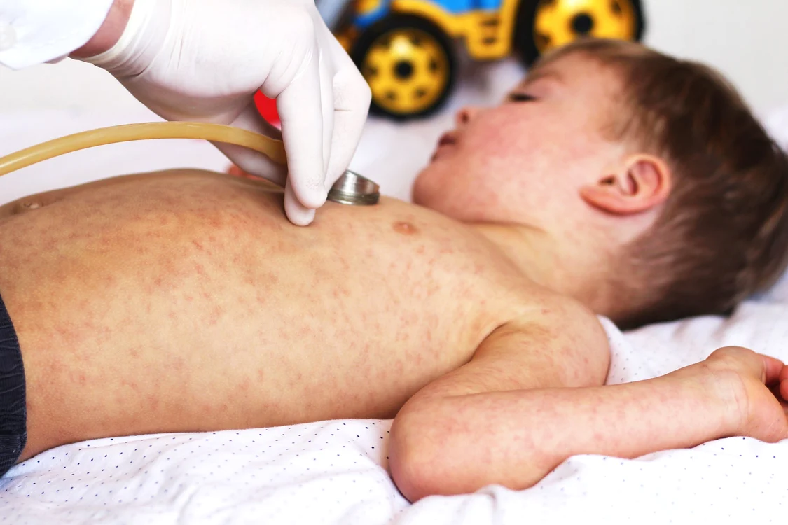 Rujeola este o boală infecțioasă care se transmite cu ușurință. FOTO Shutterstock