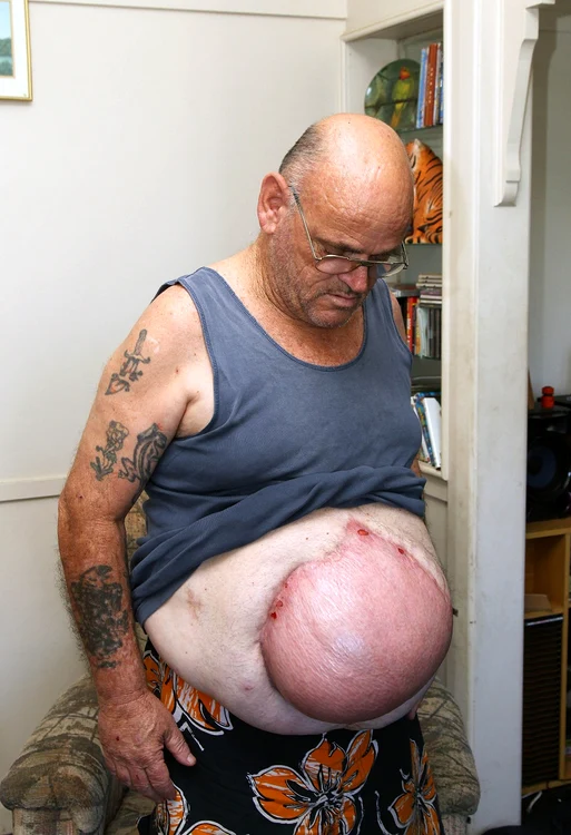 Îngrozitor! Uite ce i-a crescut în burtă, după ce a băut o bere care i-a căzut în râu