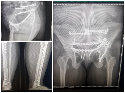Din radiografii se vede că oasele tinerei femei au fost zdrobite sub gheaţă foto arhiva andreea popa