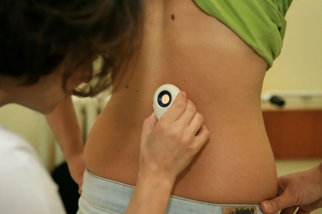 Medicul dermatolog analizează cu ajutorul dermatoscopului aluniţele pentru a le depista pe cele cu potenţial malign FOTO: Adevărul